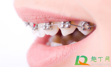 带牙套是每个牙都戴吗 带牙套是先拔牙还是后拔牙