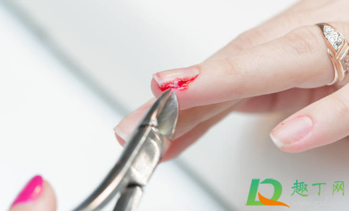 手指长倒刺用什么药膏 手指上长倒刺因为啥