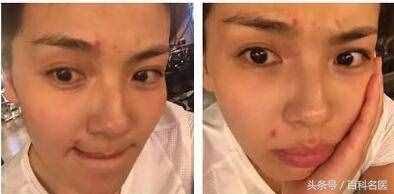 嘴周围长痘痘的原因（嘴巴周围为啥老长痘痘）