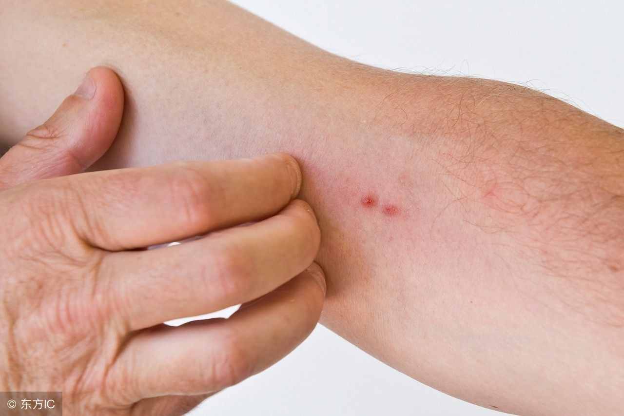 疥疮的最佳治疗方法（根治疥疮最好的方法）